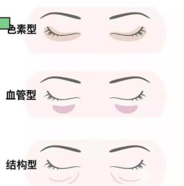 拥有罗志祥同款黑眼圈的你,还不赶快做激光去掉!
