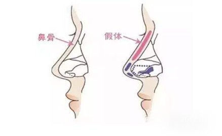 隆鼻硅胶假体透光的原因