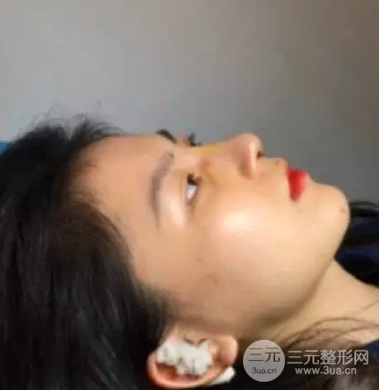 隆鼻修复手术价格多少