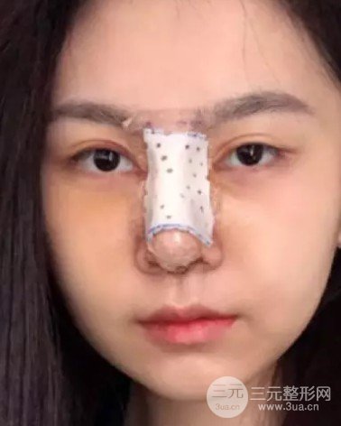 隆鼻修复手术价格多少