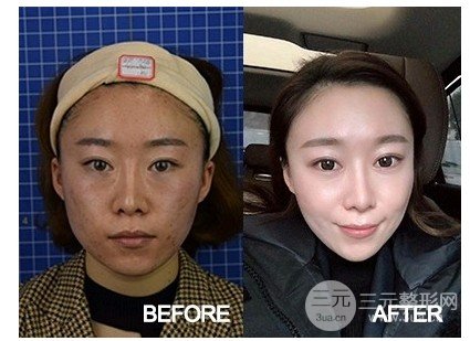 激光除皱的价格多少
