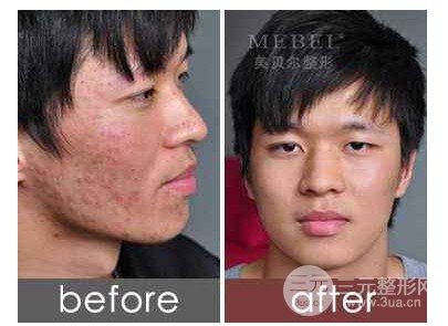 像素激光痘疤前后对比