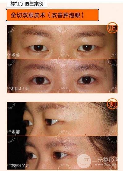 北医三院薛红宇医生双眼皮案例图