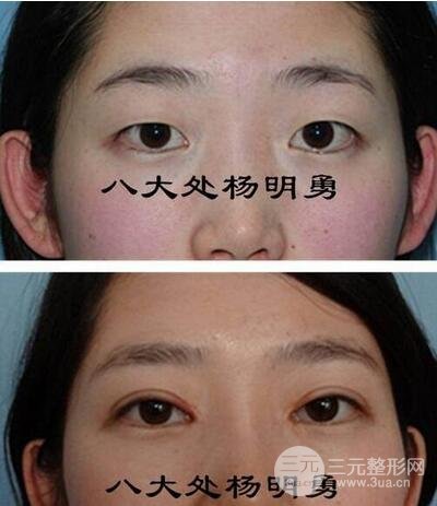 北京八大处杨明勇医生双眼皮案例图