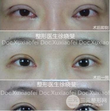 上海华美徐晓斐医生双眼皮案例图