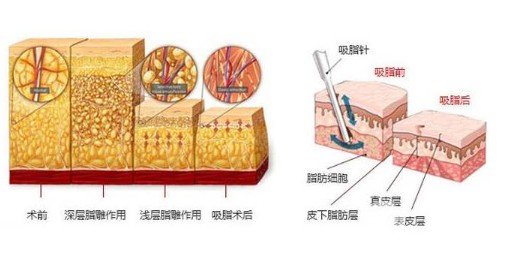 疼痛感较轻瘦腿吸脂术