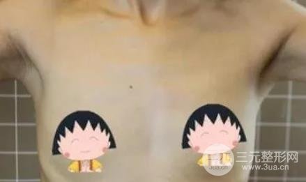 自体脂肪隆胸的价格
