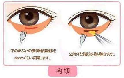 去眼袋手术区别