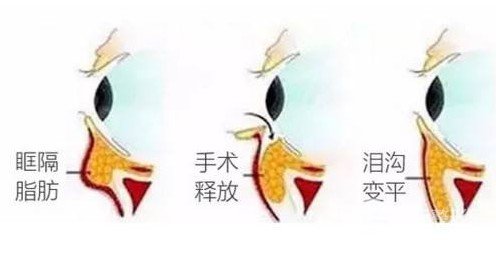 去眼袋手术区别