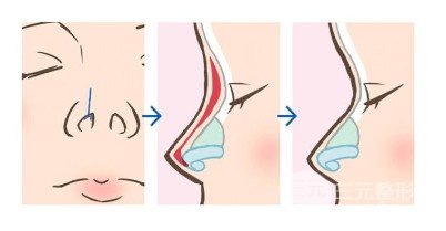 假体隆鼻会变形吗