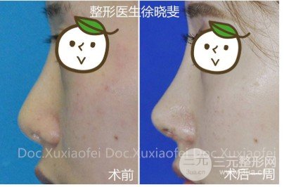 假体隆鼻会变形吗