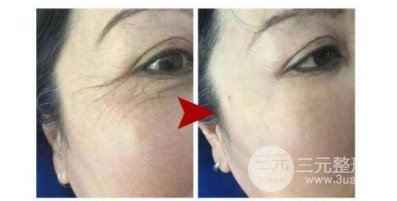 鱼尾纹去除的医美方式