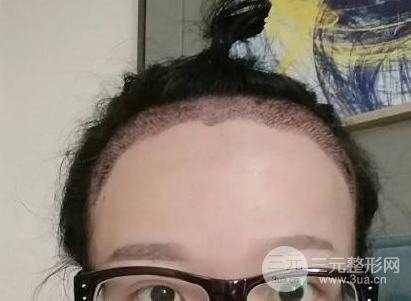 种植头发一般多少钱