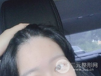 种植头发一般多少钱