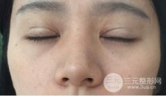 二次调整，双眼皮修复前后注意事项!