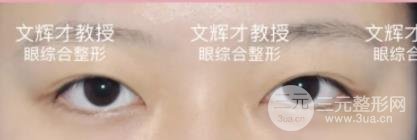 双眼皮修复前后注意事项