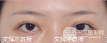 双眼皮修复前后注意事项
