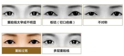 双眼皮修复前后注意事项