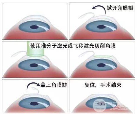 飞秒激光费用多少