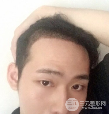 怎样种头发