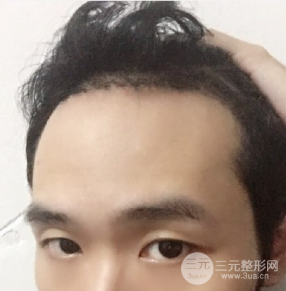 怎样种头发