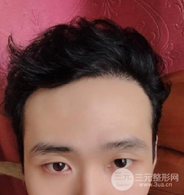 怎样种头发