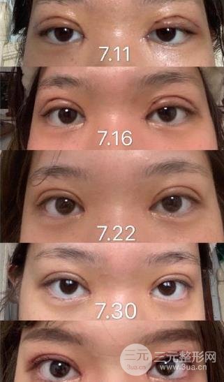 双眼皮全切过程是怎样的