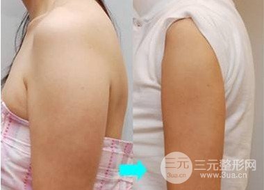 怎么瘦手臂