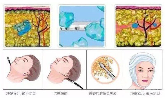 溶脂吸脂的副作用有哪些