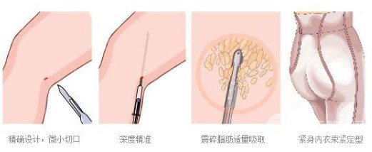 溶脂吸脂的副作用有哪些