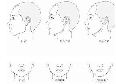 磨下颌角和切下颌角的区别