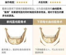 长曲线下颌角整形手术前后对比图，要注意哪些问题