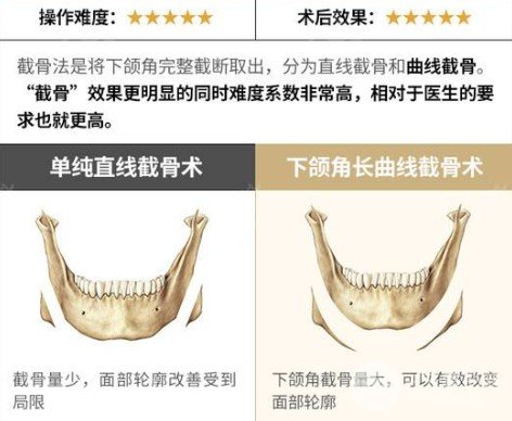 长曲线下颌角整形手术前后对比图