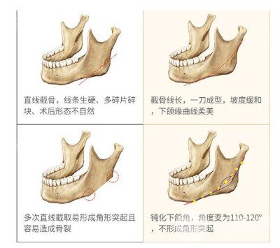 长曲线下颌角整形手术前后对比图