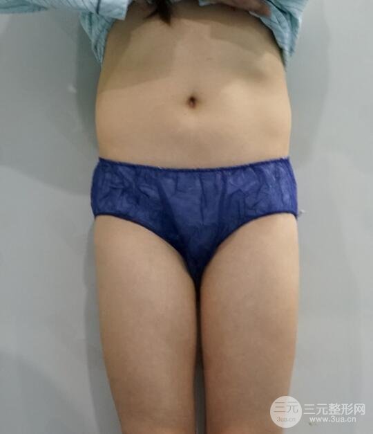 北京东方和谐整形医院吸脂瘦身案例：
