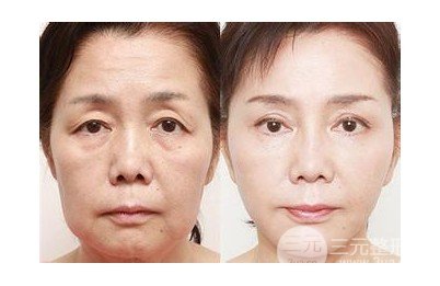 热玛吉果原理解析