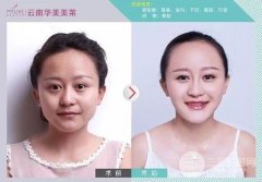脸盘子大!注射瘦脸这么方便的事儿你真的不想体验吗?