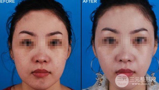 圆脸怎样变瓜子脸