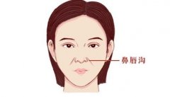 鼻唇沟填充术打玻尿酸成好吗?前后照片 鼻唇沟填充术打玻尿酸成好吗?前后照片