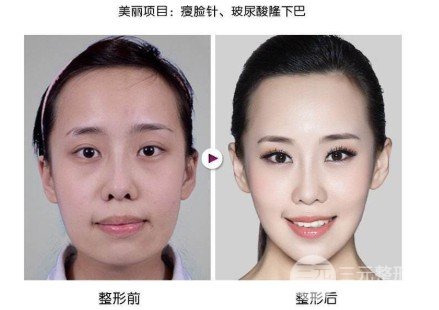 打注射瘦脸有用吗