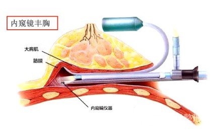 自体脂肪移植隆胸术的特点