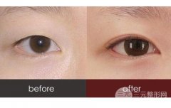 韩式定点双眼皮跟埋线的4点区别，哪种适合你?