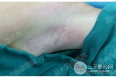 狐臭能基本根治吗？除腋臭手术有后遗症吗?