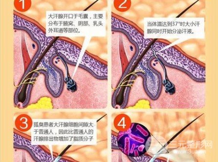 除腋臭手术有后遗症吗