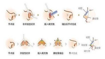 蒜头鼻整形风险大吗