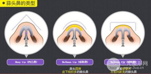 蒜头鼻整形风险大吗