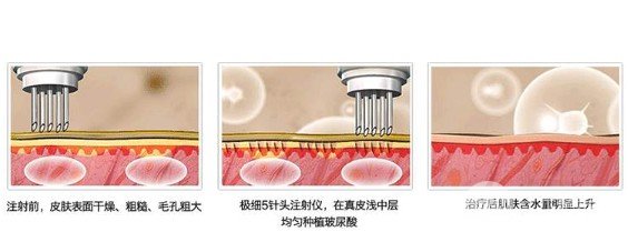 注射除鱼尾纹注射补水rd素