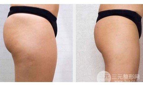 全身吸脂减肥手术多少钱