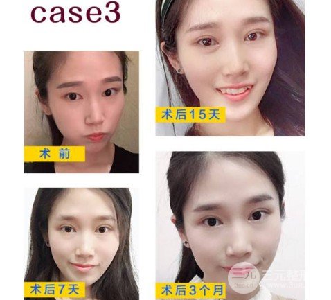 5s重睑术是怎么做的