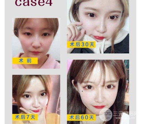 5s重睑术是怎么做的